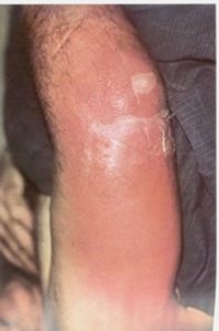 Cellulitis