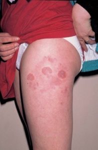 Panniculitis